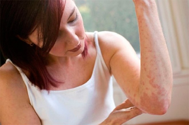 Wie man eine Allergie gegen Alkohol heilt